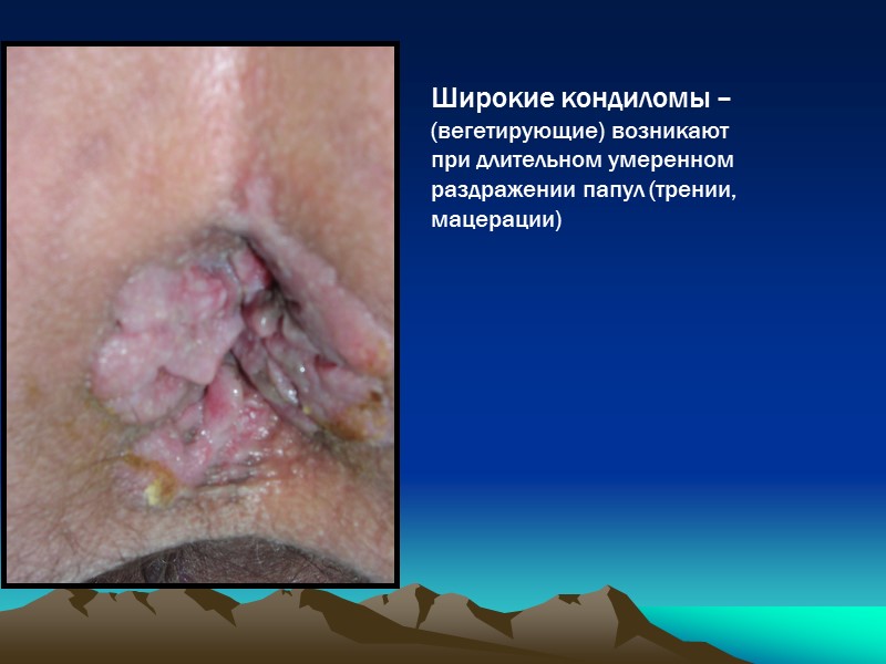 Широкие кондиломы –  (вегетирующие) возникают  при длительном умеренном раздражении папул (трении, мацерации)